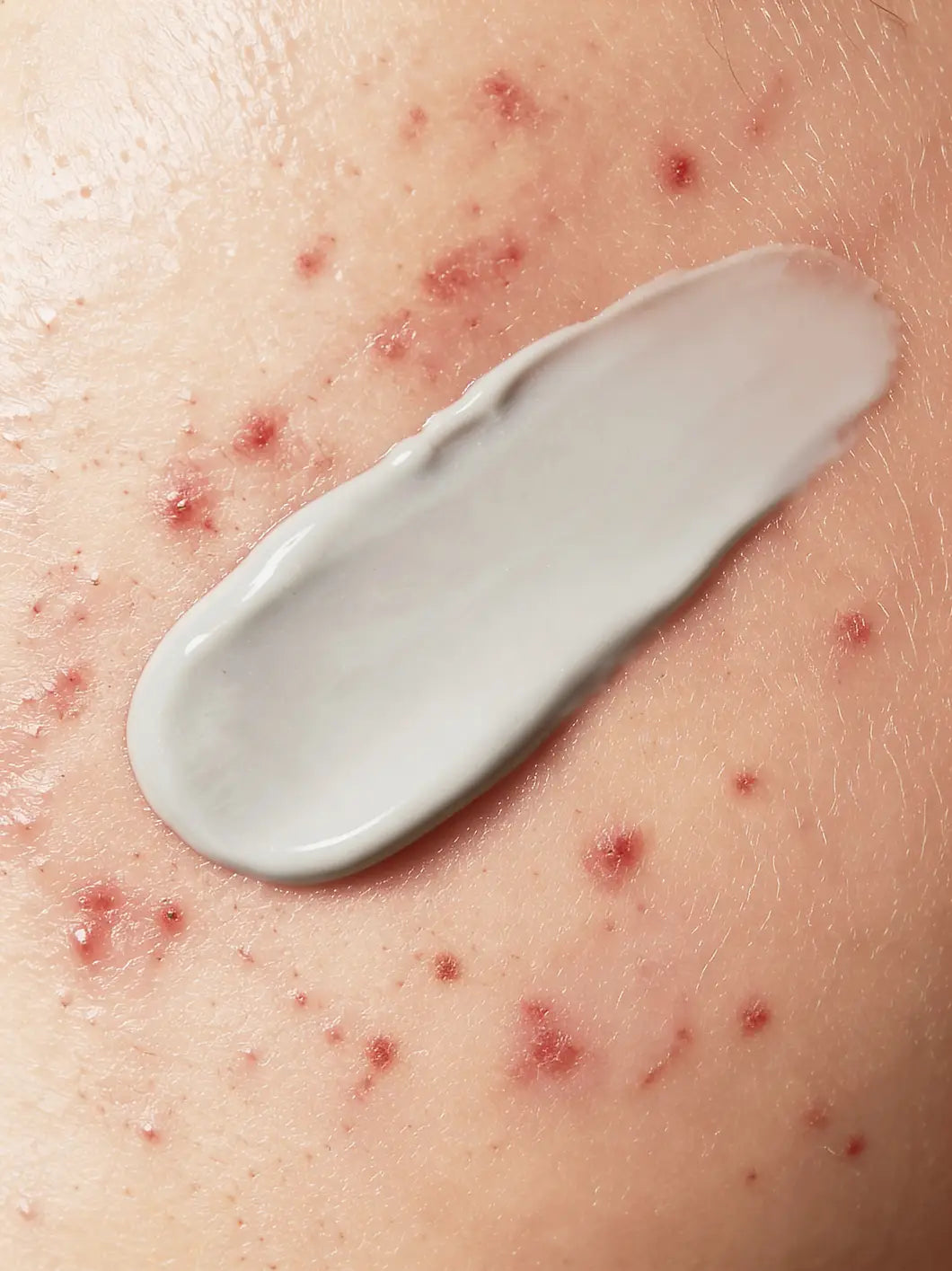 Yelf Spot Off Acne Cream – grey fluid texture applied on acne-prone skin with visible blemishes in close-up